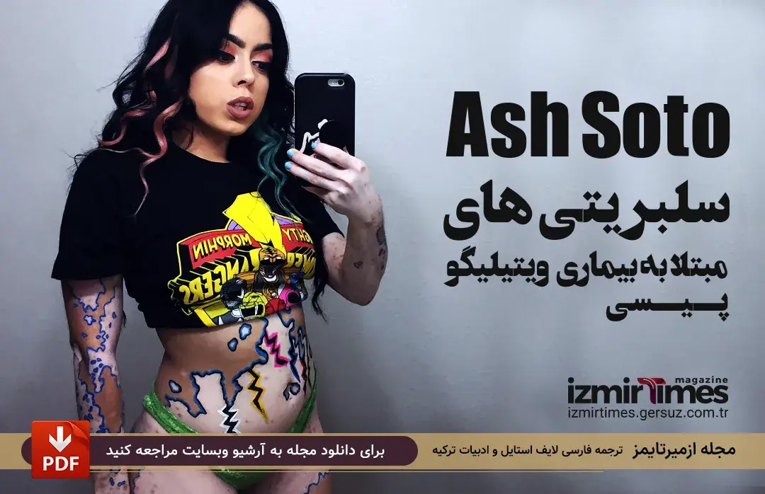 آشلی وونگ (Ash Soto) افراد مشهور مبتلا به ویتیلیگو (پیسی)