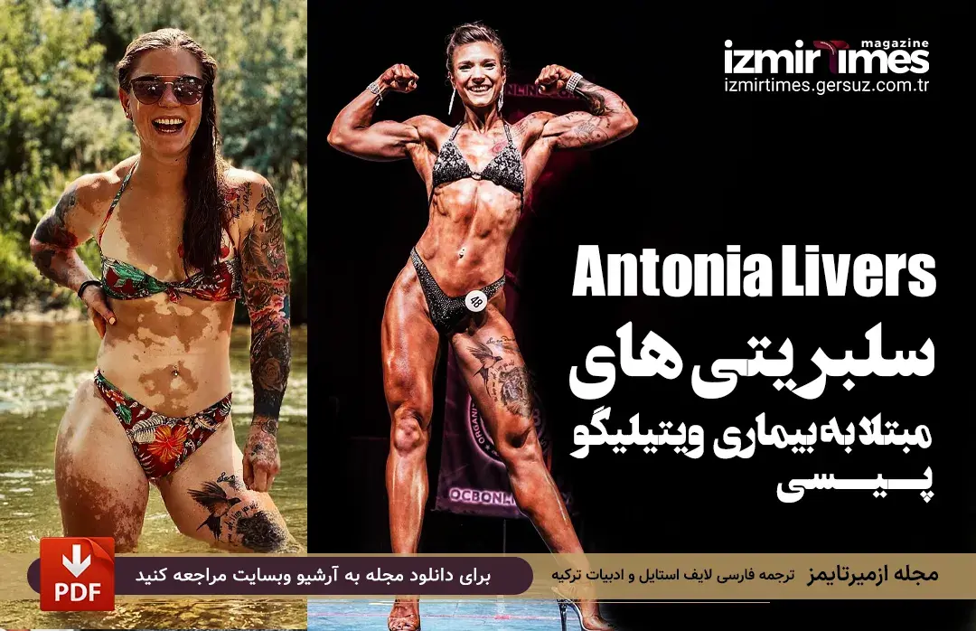 آنتونیا لیورز (Antonia Livers) افراد مشهور مبتلا به ویتیلیگو (پیسی)